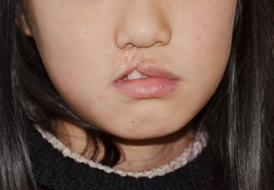 误认血管瘤为口腔炎治疗 女童上唇成"兔唇"
