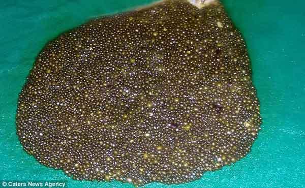 印度51岁妇女胆囊中取出1.2万颗结石(图)