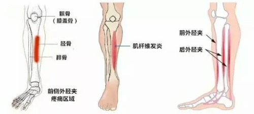 为什么跑步容易出现胫骨"骨膜炎"?