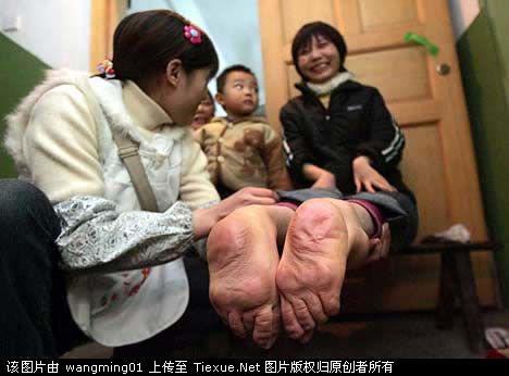 全球怪异的畸形人体 好恐怖啊