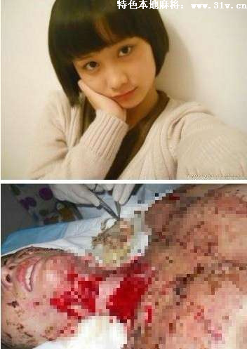 "合肥少女被毁容案"周岩递民事诉状索赔116万