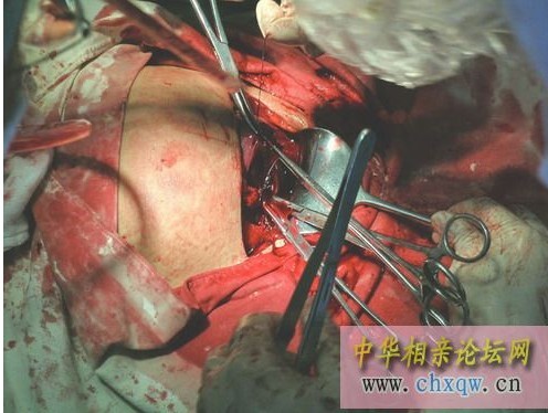 女人剖腹产全过程,珍惜那个为了你生孩子的人!