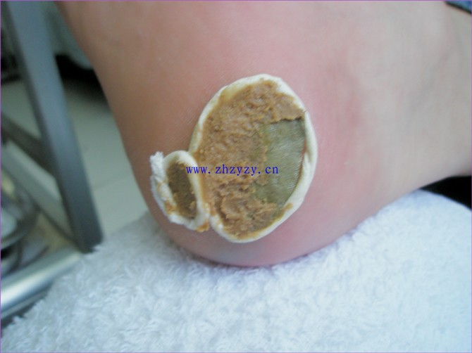 快速祛除顽固灰指甲的经验!其实非常简单!