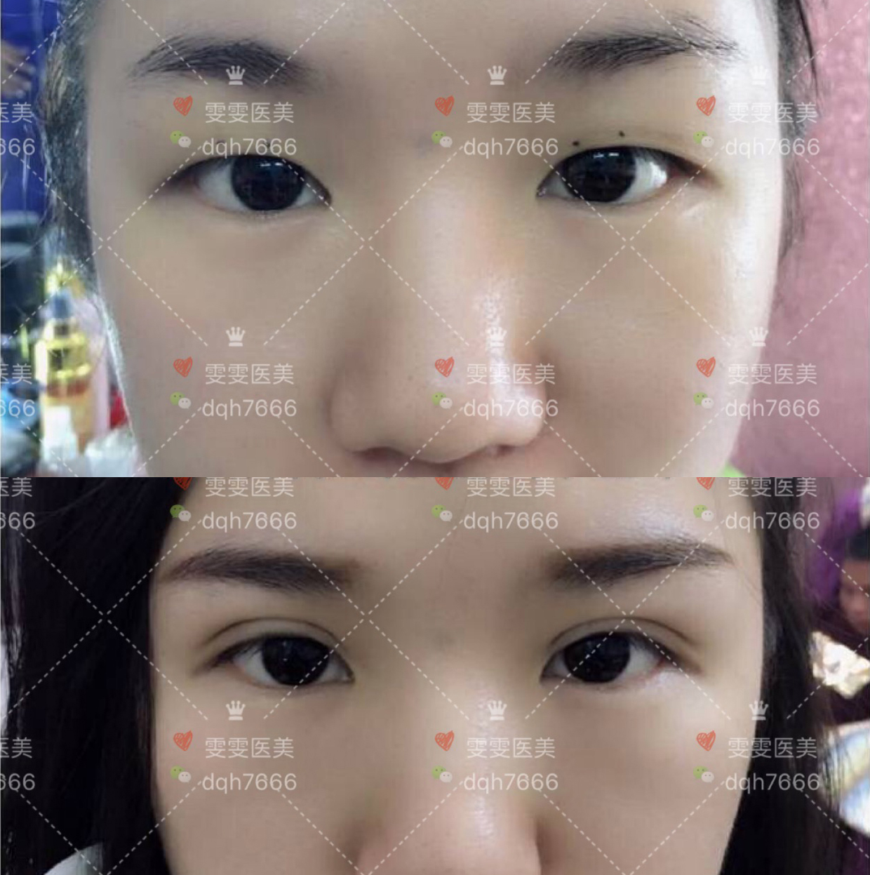 怎么样做出不留痕迹又自然的双眼皮?不开刀,不埋线!