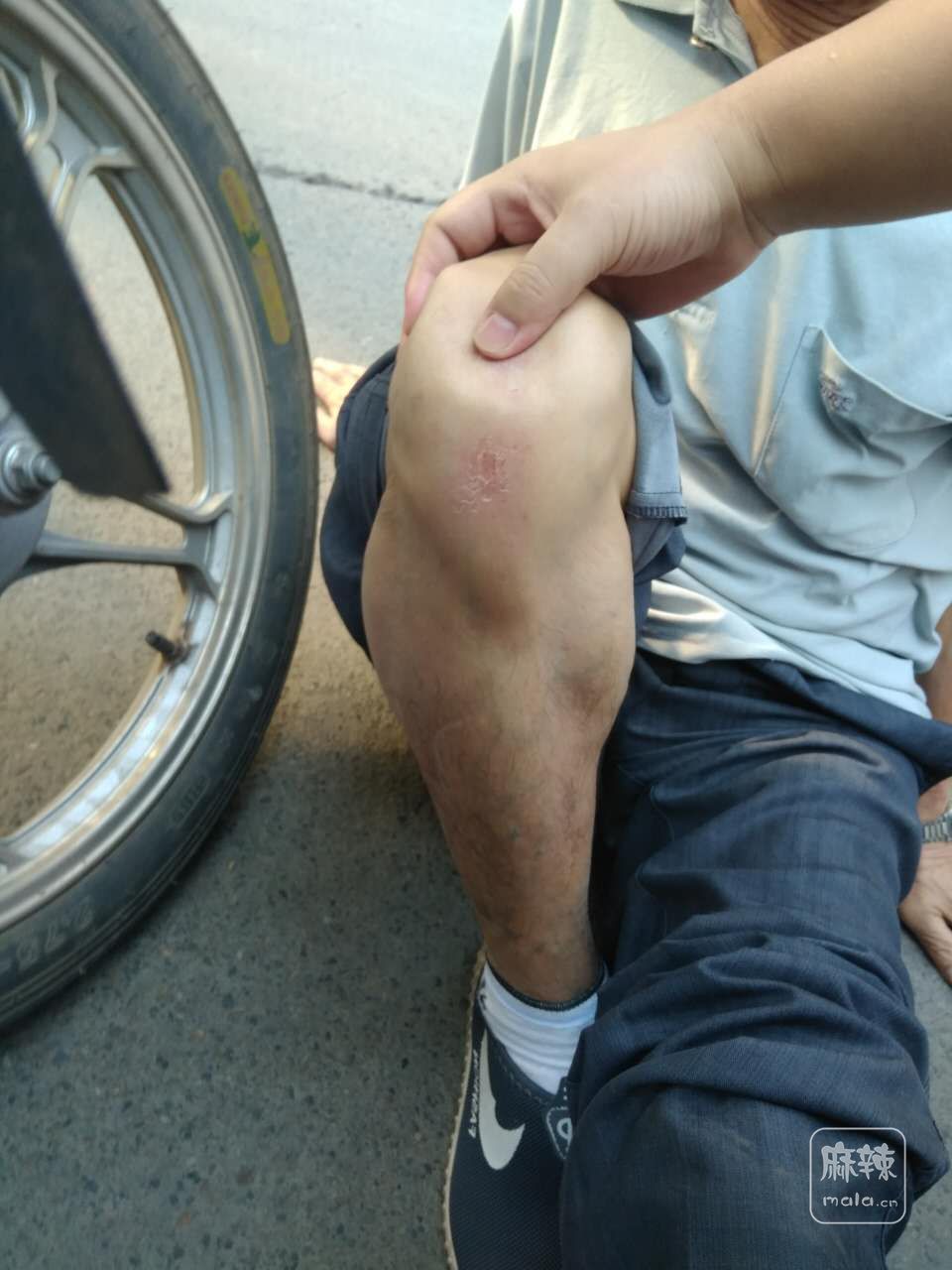 蓬安这摩托师傅摊上事了,据说撞断老人脚咯!