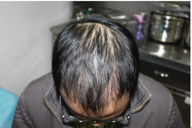 植发医生也曾有过脱发烦恼,用亲身经历改变别人的人生