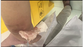 换药清创-塞药�