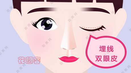 埋线双眼皮可以维持多久?