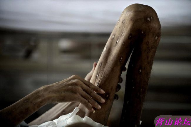 看看艾滋病人的最后归属